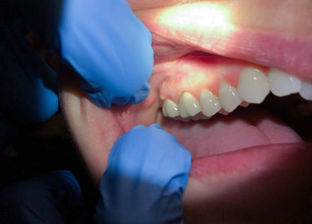 Best Emergency Treatment for Dental Infections or Abscesses in Union, OR