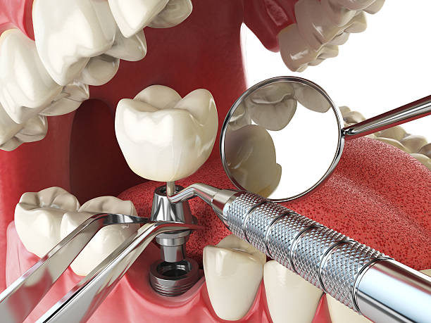 Best Emergency Treatment for Dental Infections or Abscesses in Union, OR